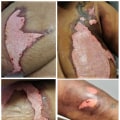 The Healing Process of Second-Degree Burns: Managing Scars and Complications