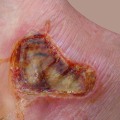 The Healing Process of Burns: What You Need to Know