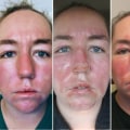 The Healing Process of Second-Degree Burns