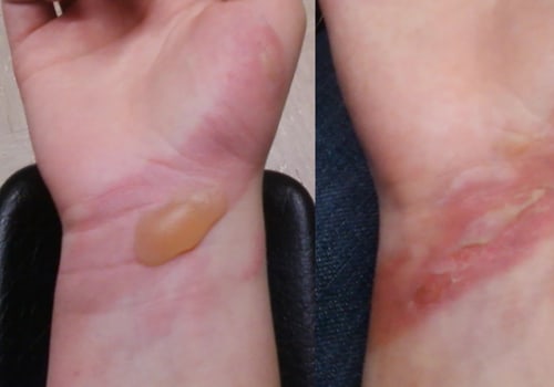 The Healing Process of Second-Degree Burns