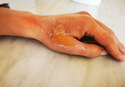 When to Seek Medical Attention for a Second-Degree Burn