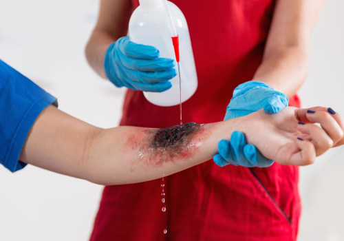 The Importance of Seeking Medical Care for Burns