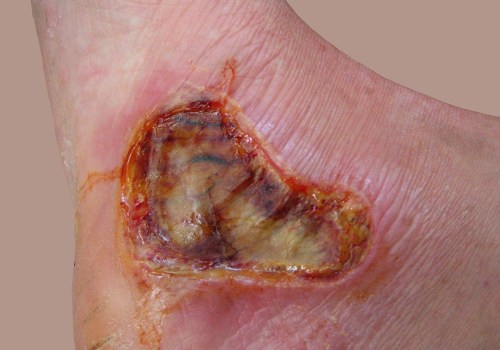 The Healing Process of Burns: What You Need to Know