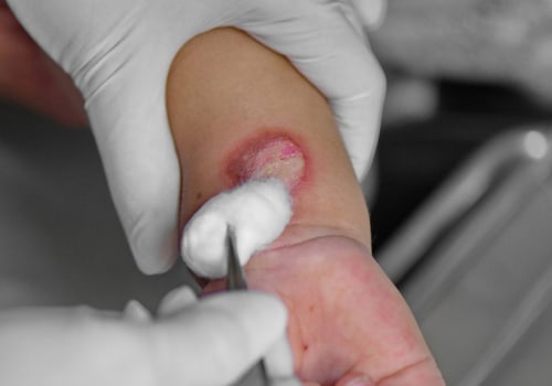 How to Treat Second-Degree Burns to Prevent Scarring