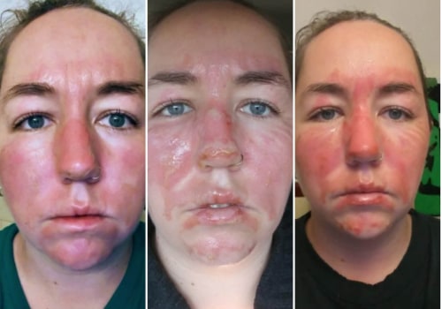 The Healing Process of Second-Degree Burns: What to Expect and How to Care for Your Skin