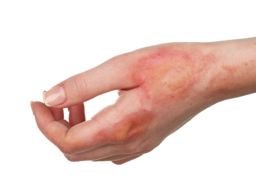 The Importance of Identifying and Treating Burn Infections